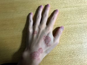 手の湿疹　昨日
